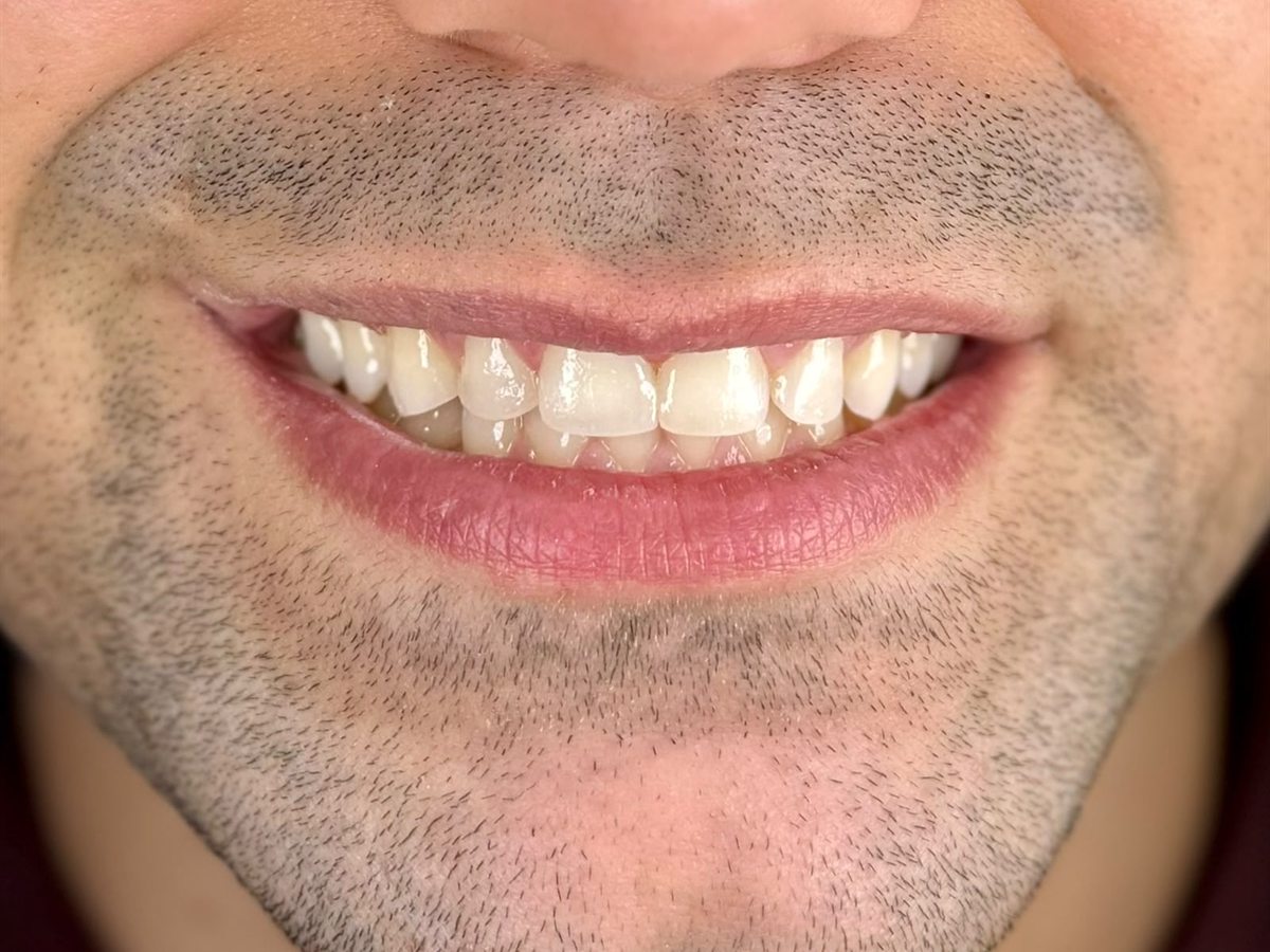 After treatment: an even, brighter smile line