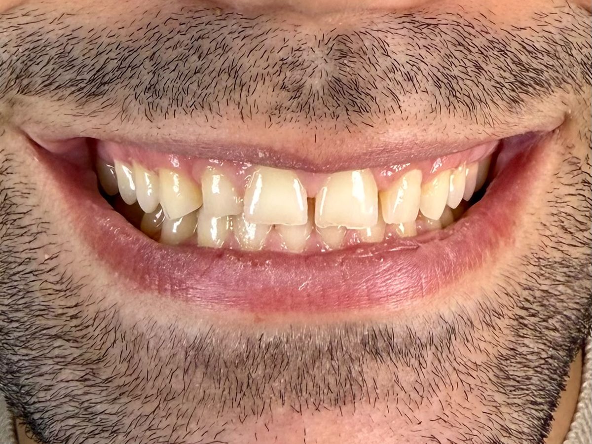Before treatment: chipped, uneven and discoloured front teeth