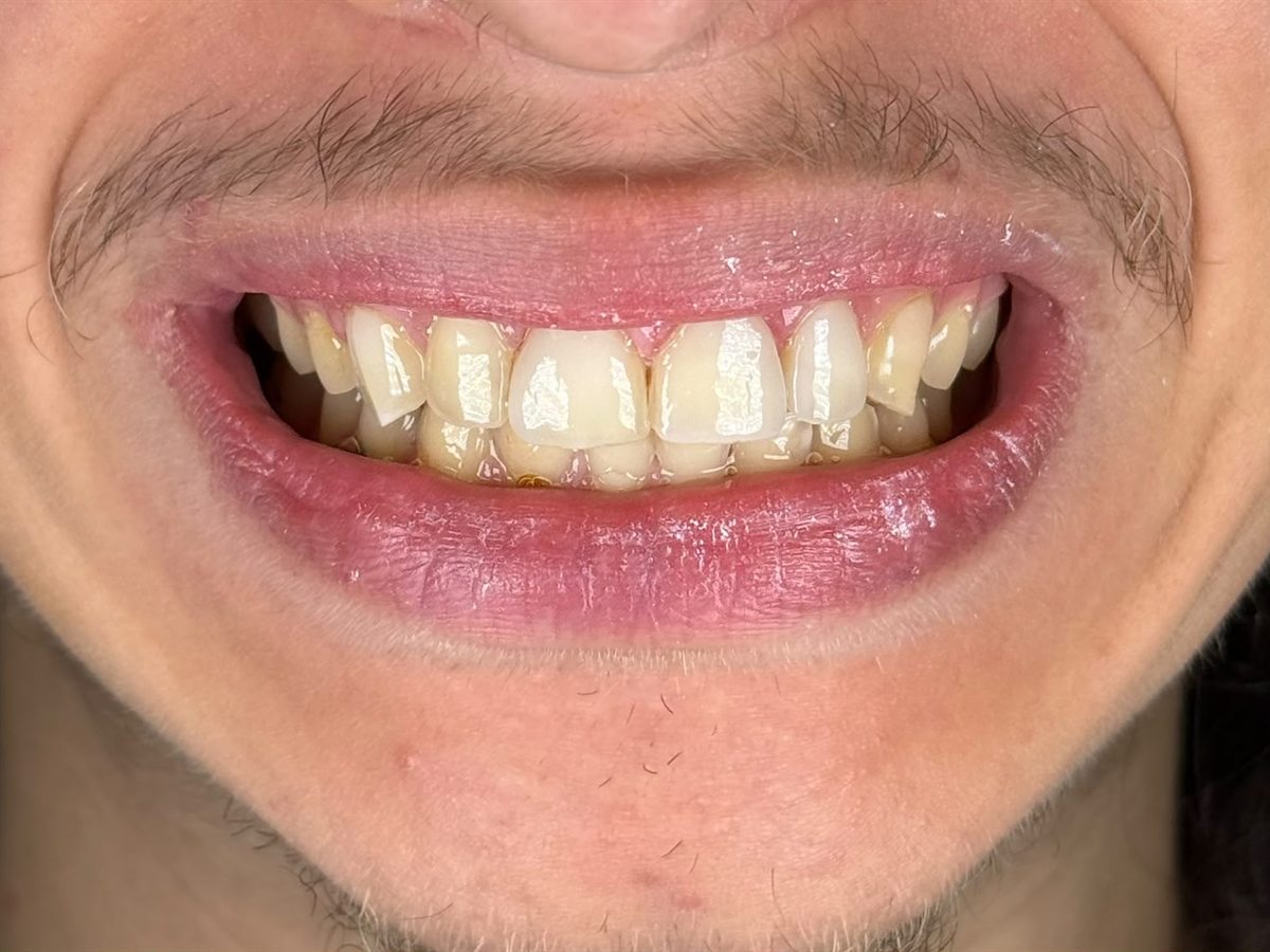 After treatment: restored tooth shape and length