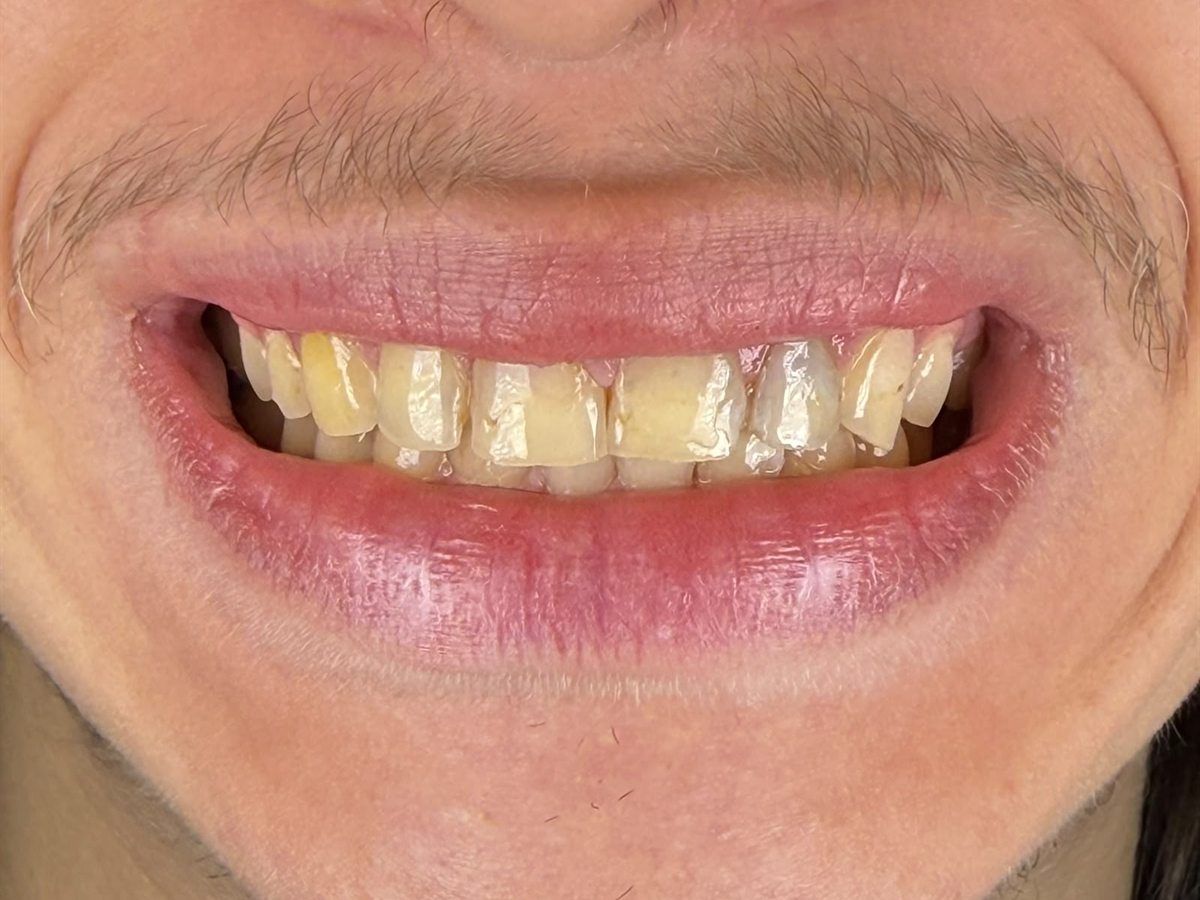 Before treatment: heavily worn and eroded upper teeth