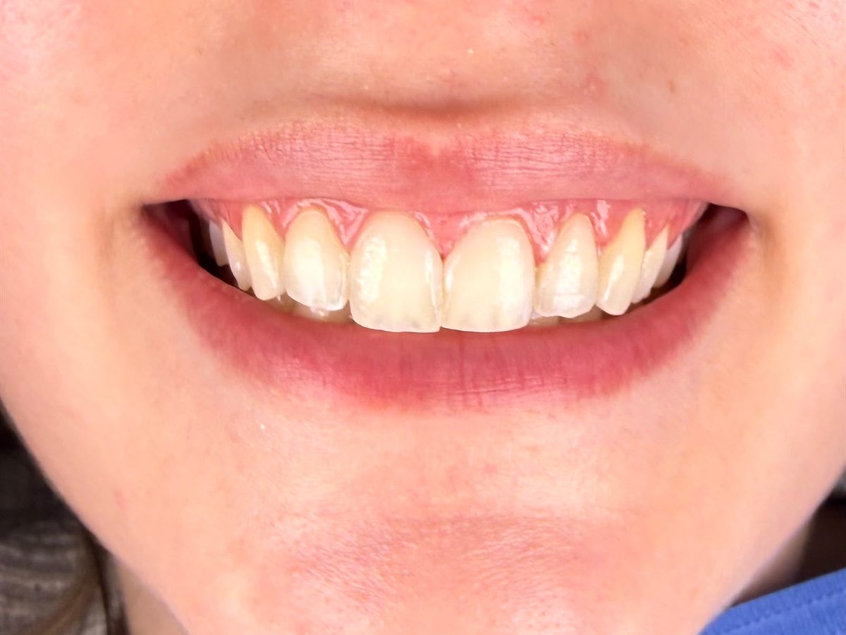 After treatment: visibly lighter tooth shade