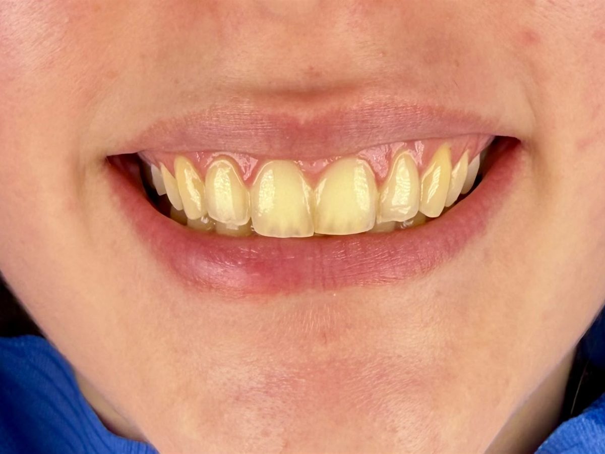Before treatment: yellowed tooth shade