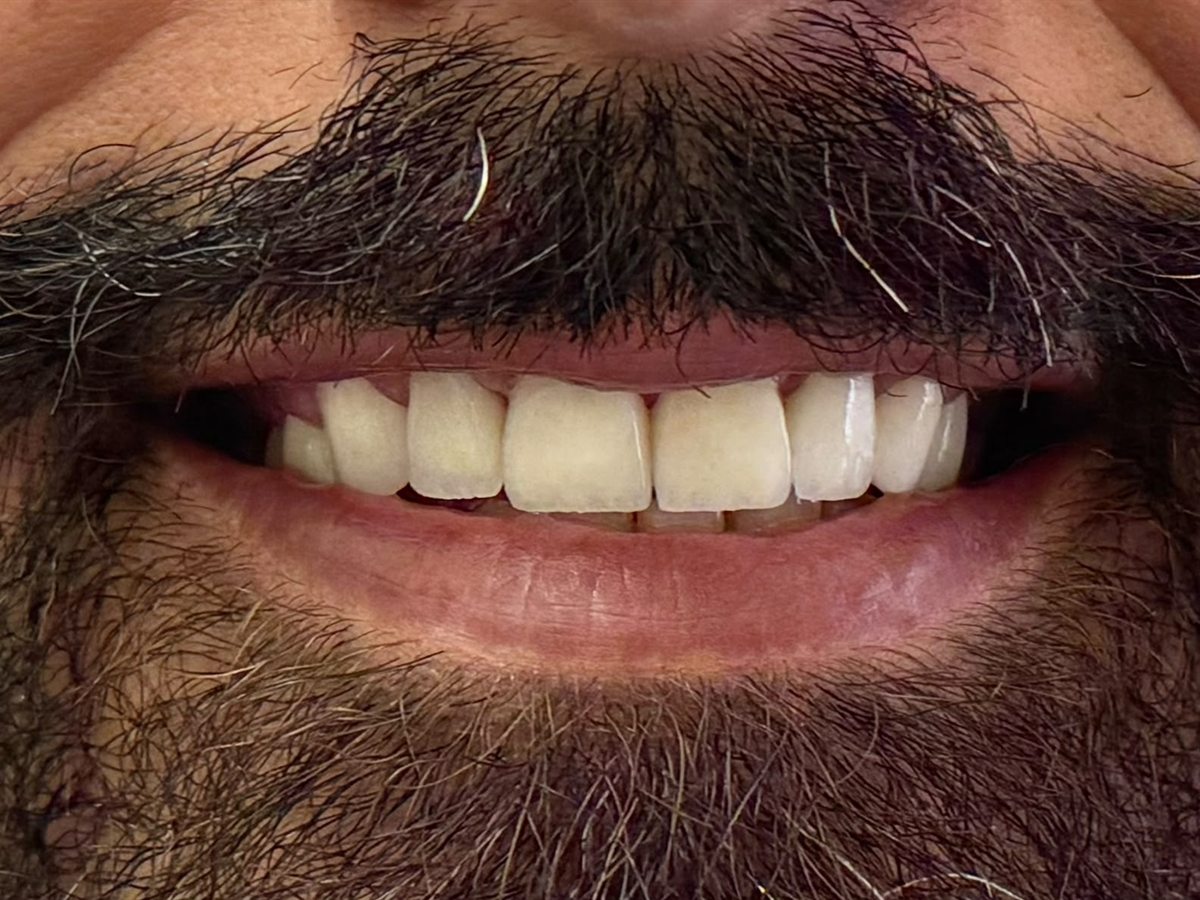 After treatment: a complete, even upper arch