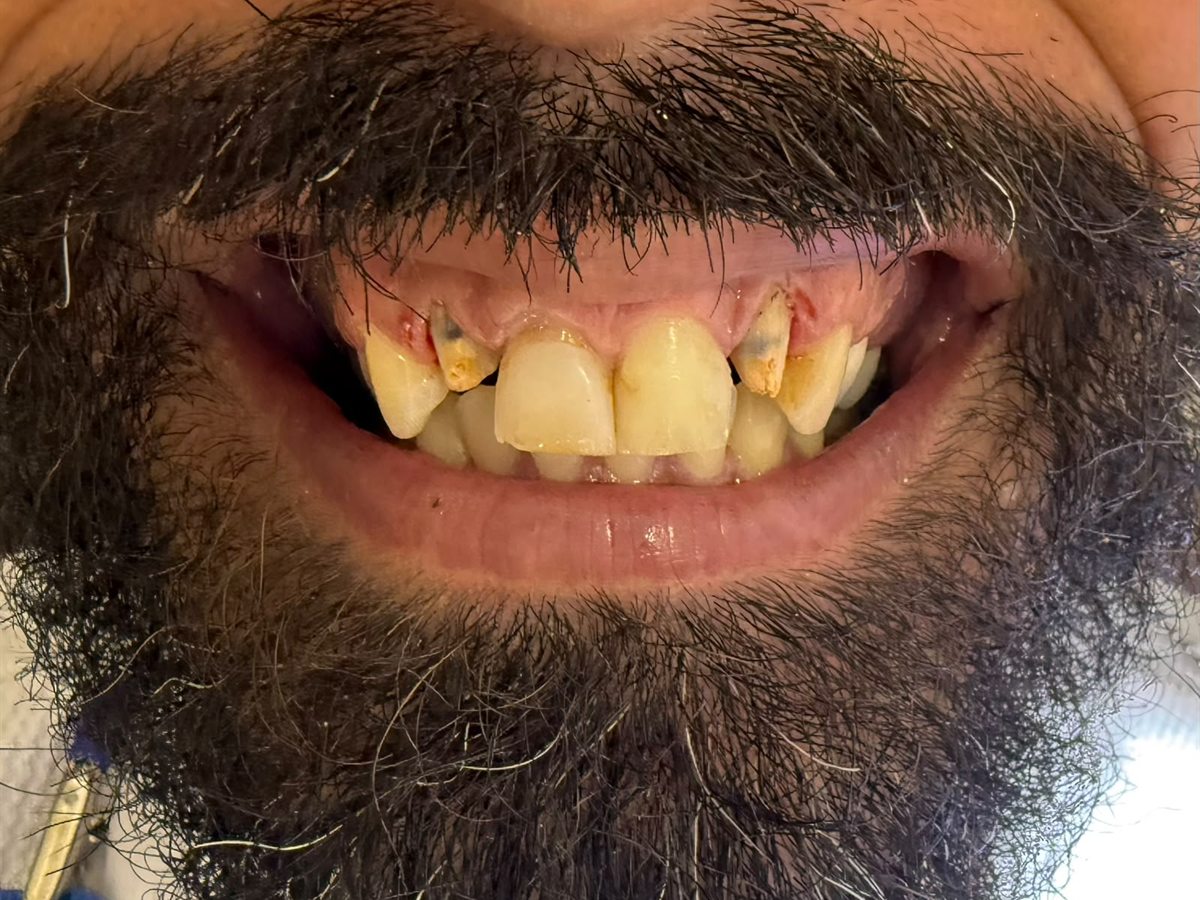 Before treatment: extensive decay and broken upper teeth