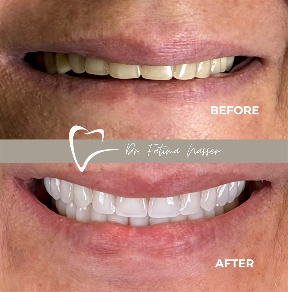Before and after: full-arch ceramic restoration