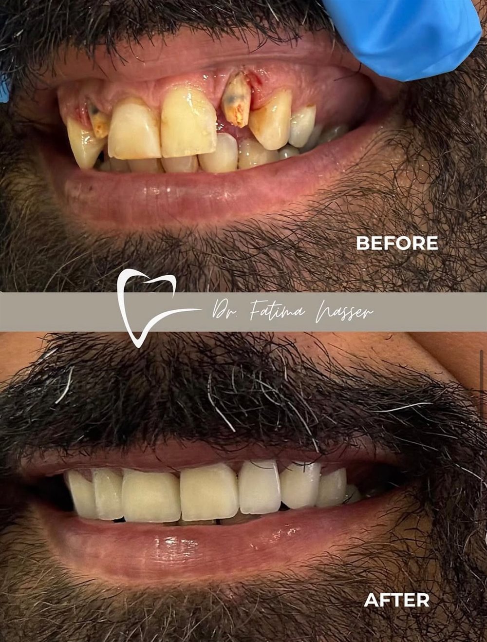 Before and after: severe decay rebuilt into a complete smile