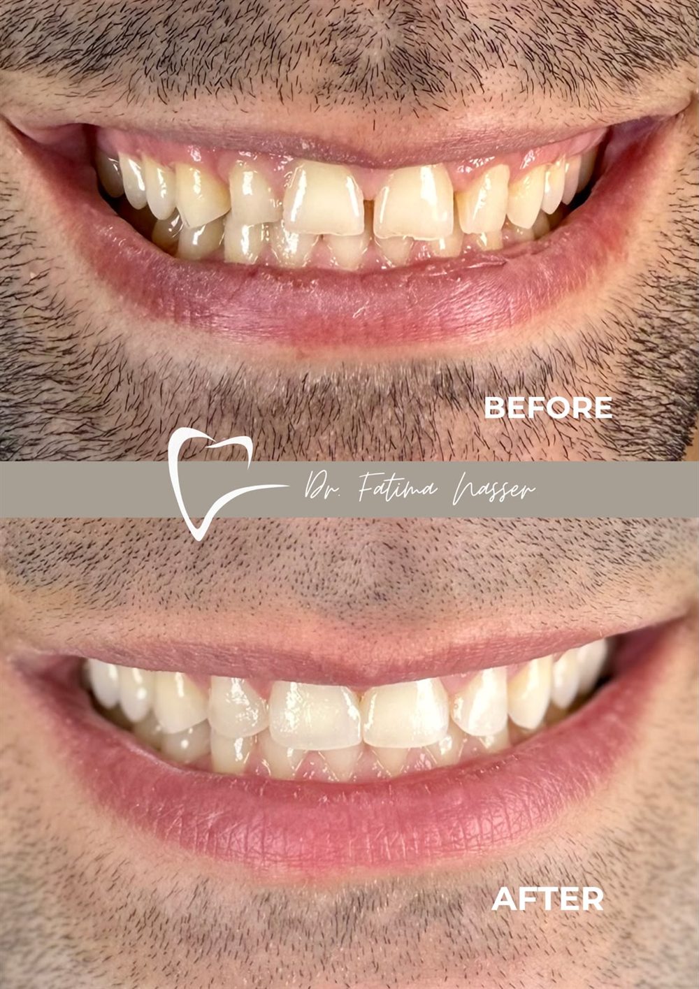 Before and after: alignment and shade correction